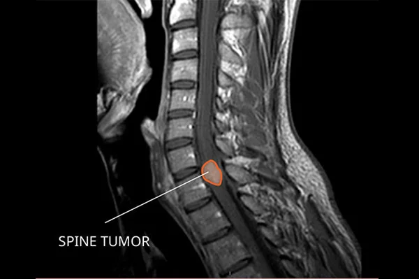 Spine Tumor