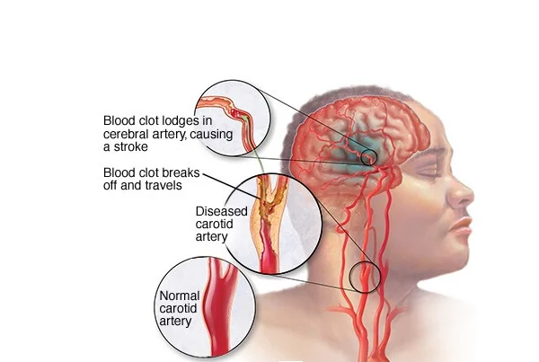 Brain Hemorrhage
