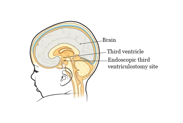 Hydrocephalus